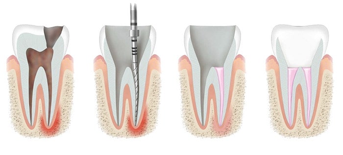 Endodontoja: dantų kanalų gydymo žingsniai