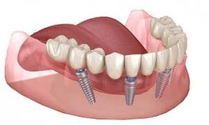 <<Visi ant 4>> metodika atkūriami visi žandikaulio dantys ant 4 implantų fiksuotu protezu